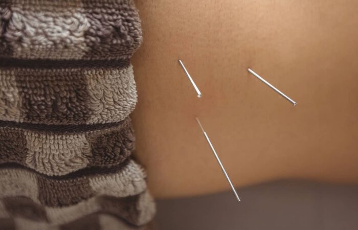 acupuncture program Minnesota
